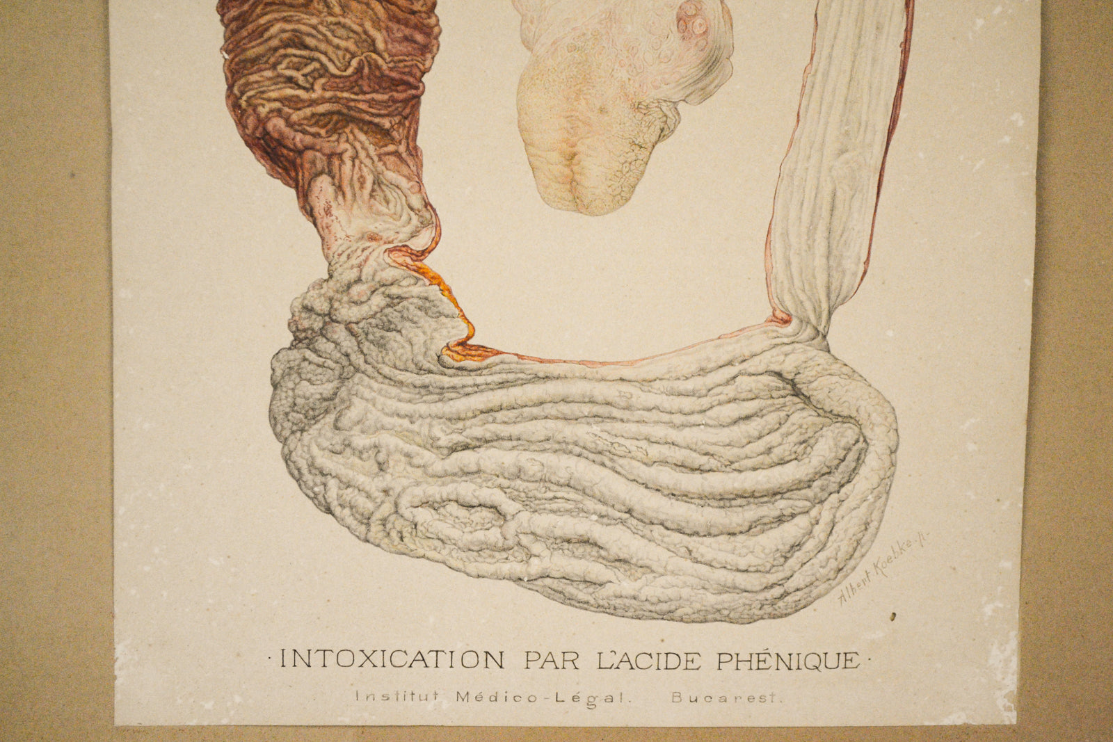 Forensic Medicine Illustration - Phenol Poisoning